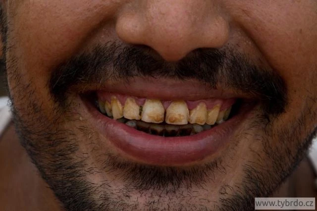 Červené zuby jsou typické pro milovníky betelu. 